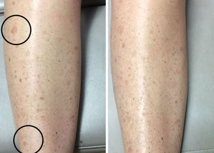 laser tattoo removal fort smith ar best tatto 2017 laser tattoo removal fort smith ar best tatto 2017